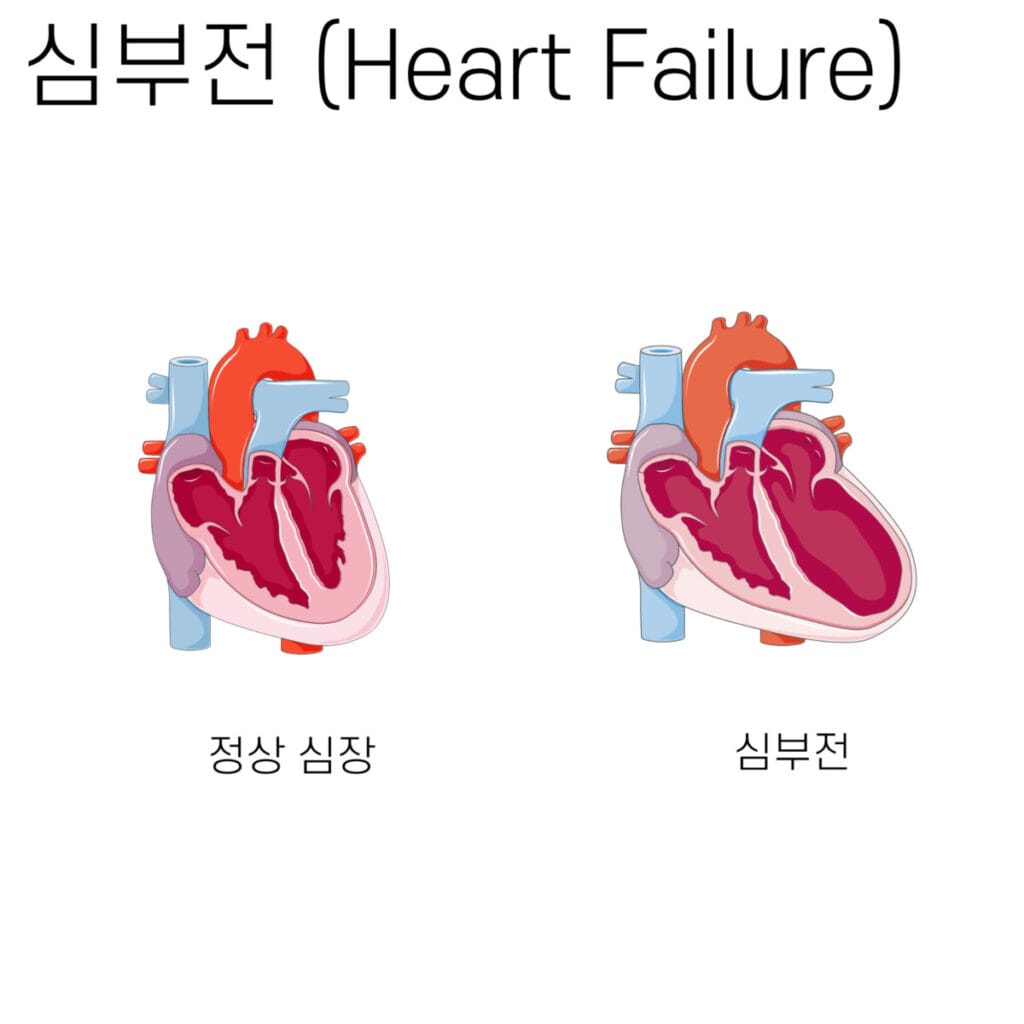 심부전 심장 구조 변화