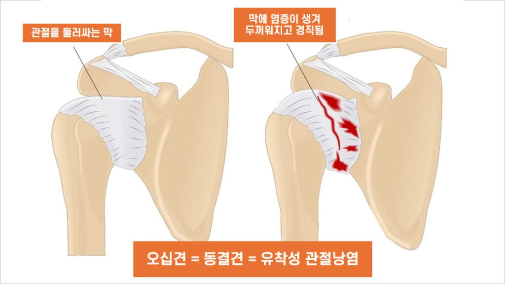 오십견, 유착성 관절낭염